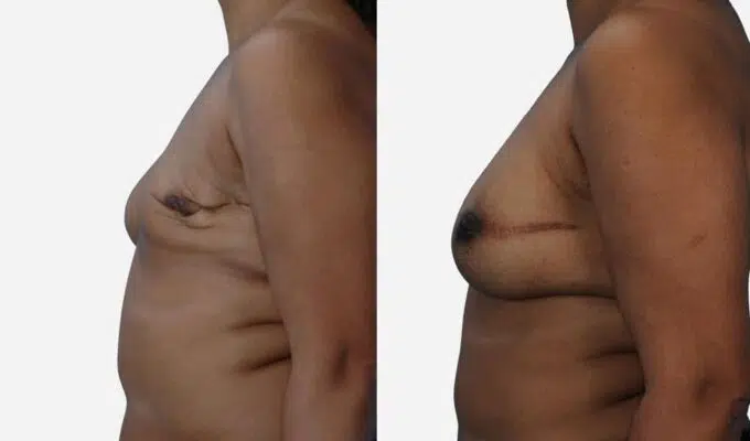 Poitrine de femme profile avant et apres une reconstruction mammaire total du sein gauche par injection de graisse Dr Benjamin Sarfati paris