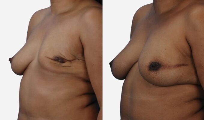 Poitrine de femme avant et apres reconstruction mammaire totale du sein gauche par injection de graisse lipofilling Dr Benjamin Sarfati paris