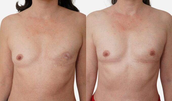 Poitrine avant et apres reconstruction mammaire totale du sein gauche par injection de graisse lipofilling Dr Benjamin Sarfati paris