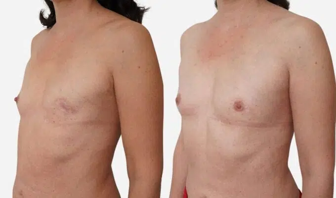 Poitrine de femme de profile  avant et apres une resonstruction mammaire total du sein gauche par injection de graisse Dr Benjamin Sarfati paris