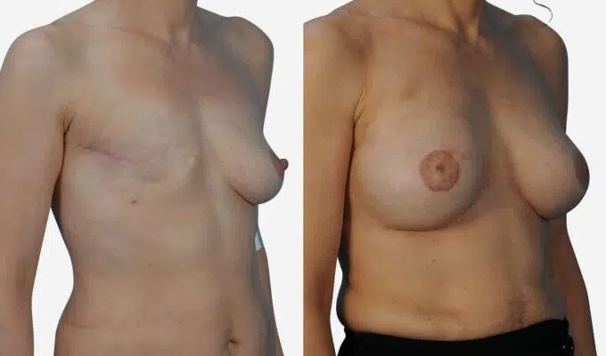 Poitrine avant et apres une reconstruction mammaire par prothese anatomique Dr Benjamin Sarfati paris