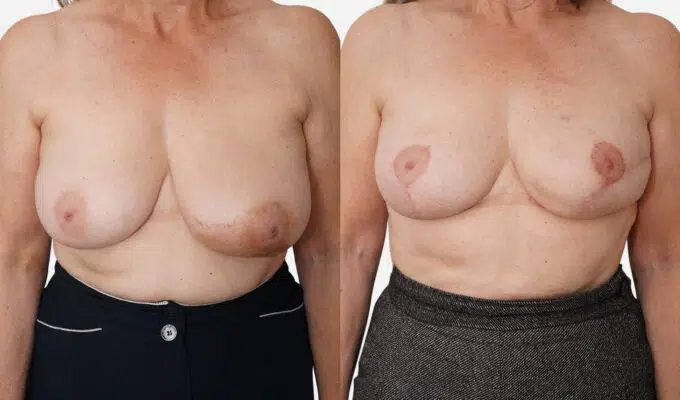 Poitrine avant et apres une reconstruction mammaire par prothese anatomique Dr Benjamin Sarfati paris