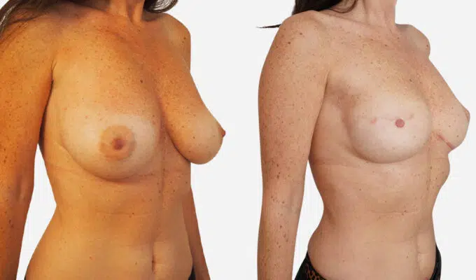 Poitrine avant et apres une reconstruction mammaire par prothese anatomique Dr Benjamin Sarfati paris