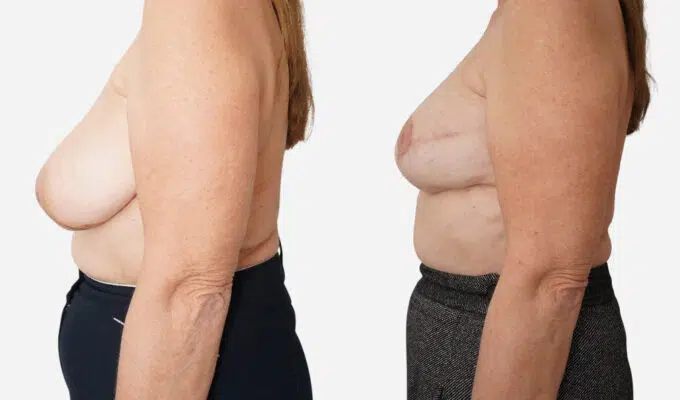 Poitrine de femme de profile gauche avant et apres une reconstruction mammaire par prothese anatomique Dr Benjamin Sarfati paris