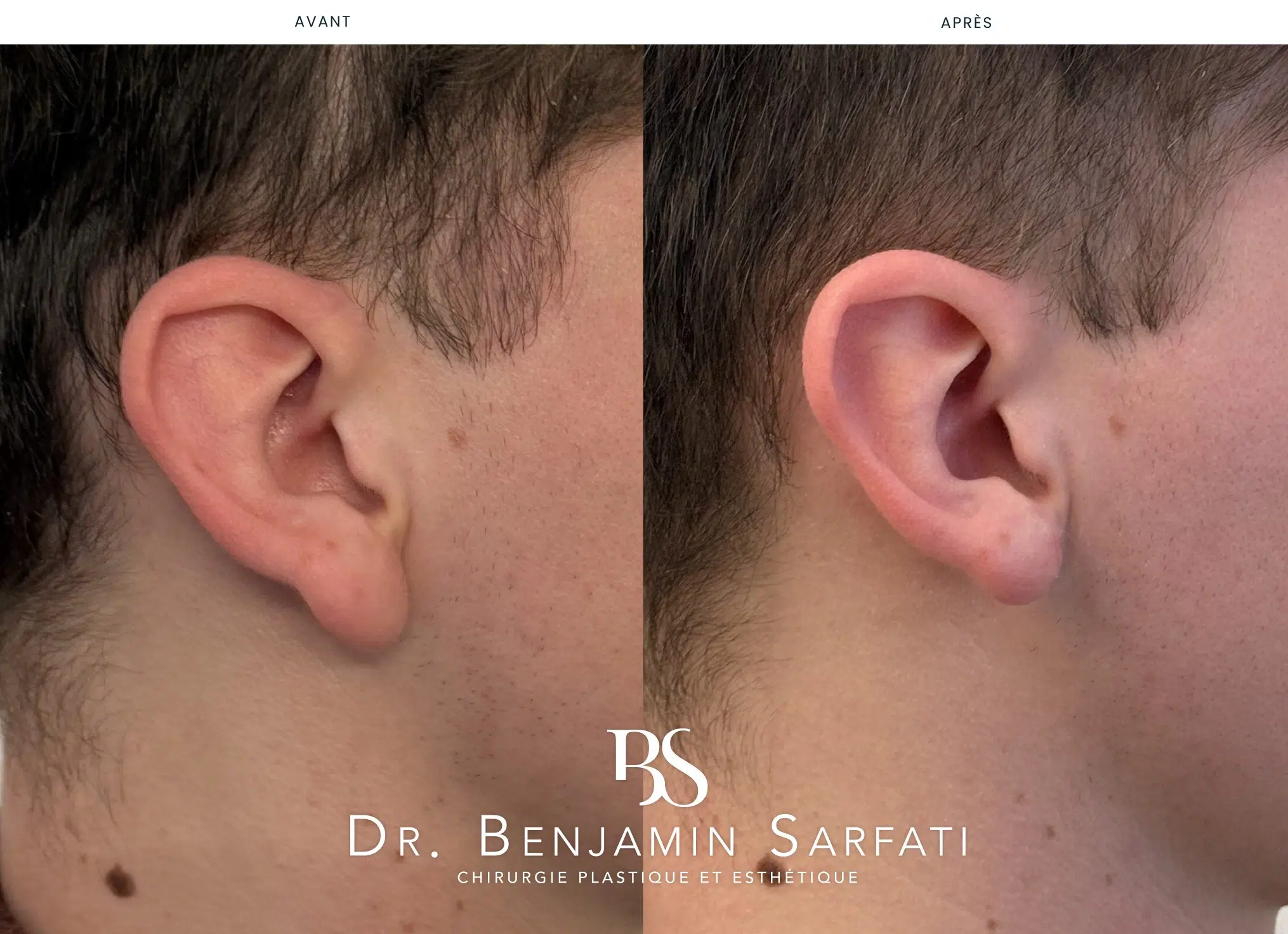 Réduction des lobes d’oreilles