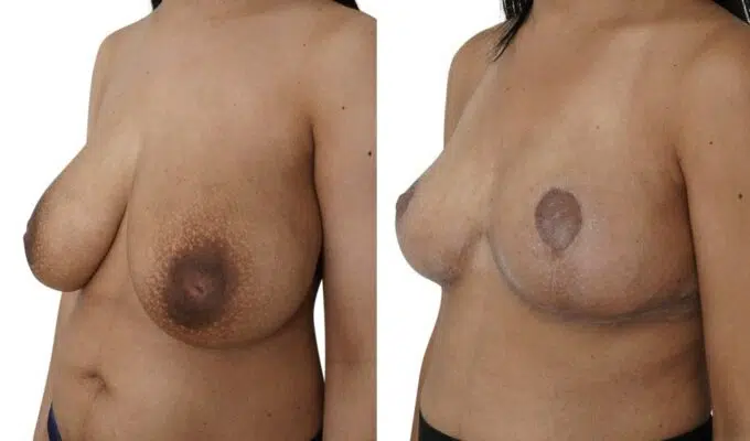 Poitrine de femme avant et apres reduction mammaire bilaterale Dr benjmin Sarfati Paris