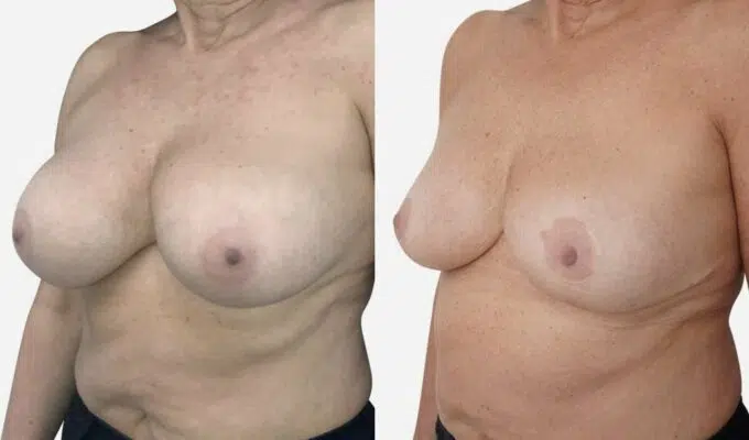 Poitrine de femme avant et apres reduction mammaire bilaterale Dr benjmin Sarfati Paris