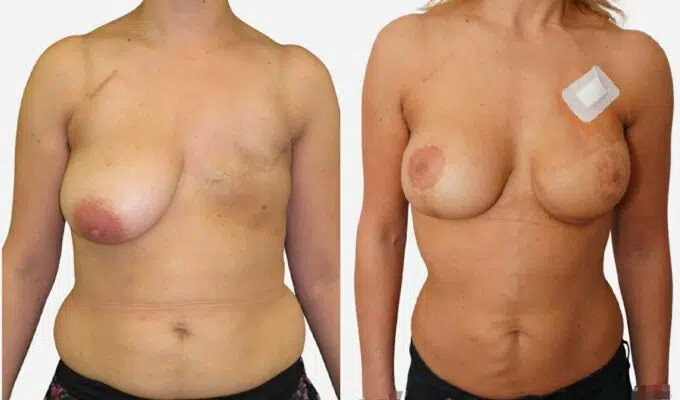 Poitrine avant et apres reconstruction mammaire par lambeau de grand dorsal Dr Benjamin Sarfati paris