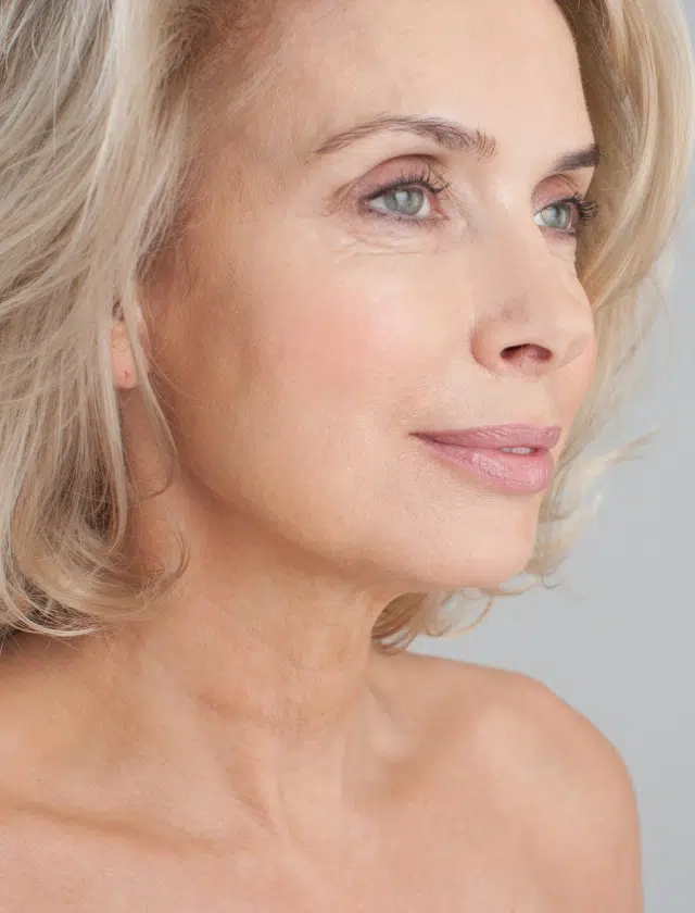 Visage de femme avant injection d acide hyaluronique pour combler les rides Dr bejamin Sarfati paris