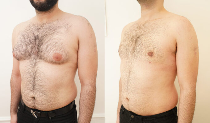 Poitrine d un homme avant et apres cure de gynecomastie par lipoaspiration de la glande Dr Benjamin Sarfati paris