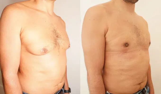 Poitrine d un homme avant et apres cure de gynecomastie avec laser urgotouch Dr Benjamin Sarfati paris