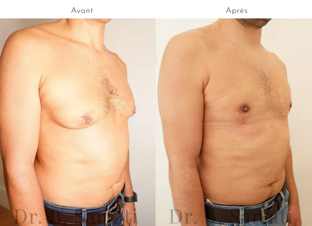 Poitrine d homme avant et apres cure de gynecomastie par lipoaspiration avec laser urgotouch Dr Benjamin Sarfati paris