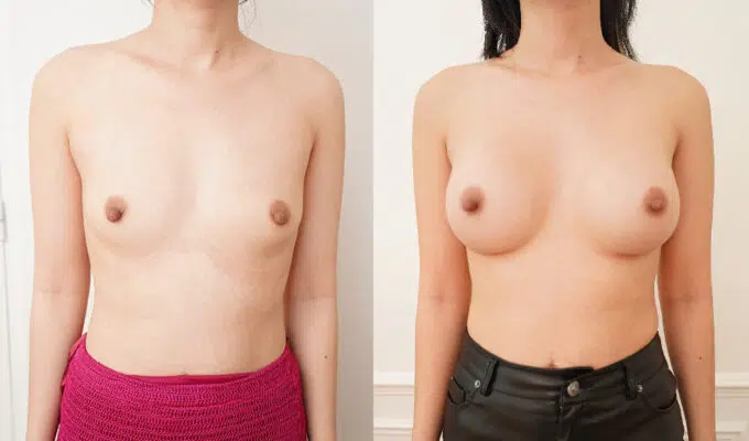 Poitrine avant et apres une augmentation mammaire par prothese rondes Dr Benjamin Sarfati paris