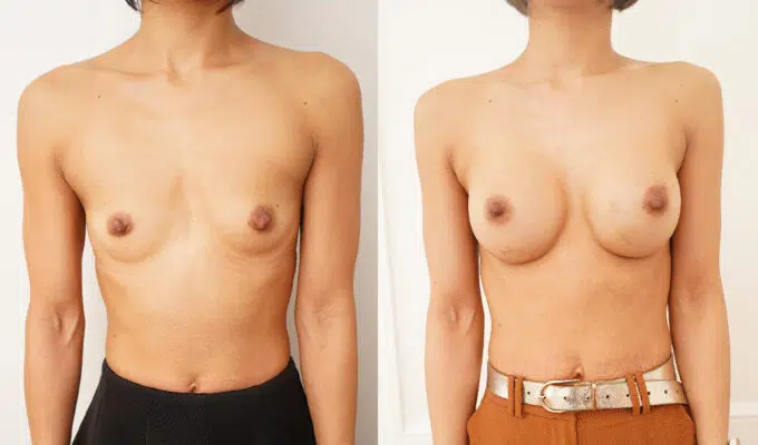 Poitrine de femme avant et apres une augmentation mammaire par prothese rondes par voies sous mammaires Dr Benjamin Sarfati paris