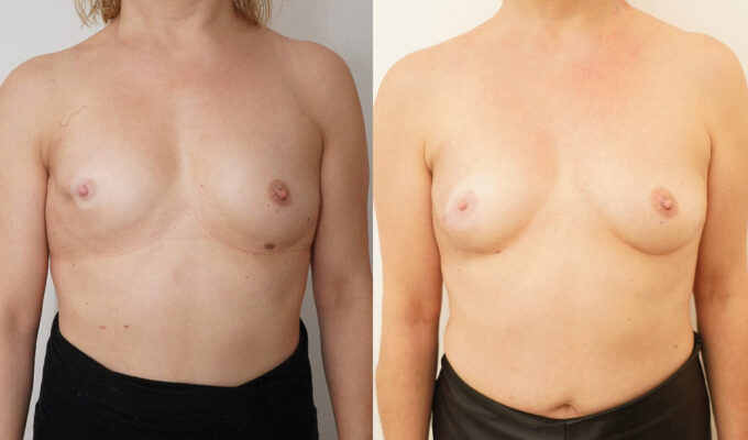 Lipofilling d'un seul sein (sein droit) | Dr Benjamin Sarfati | Paris
