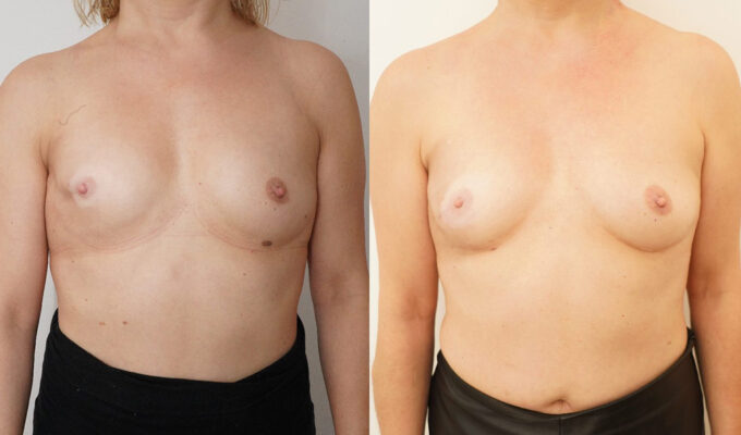 Poitrine avant et apres lipofilling du sein droit et correction de tumorectomie Dr Benjamin Setrfati paris