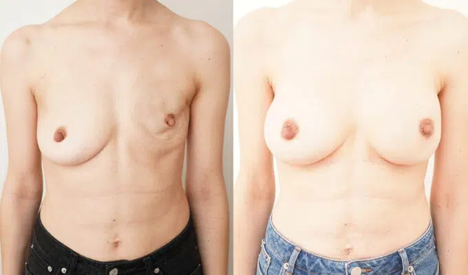 Poitrine de femme avant et apres reconstruction mammaire secondaire du sein gauche par prothese Dr Benjamin Sarfati paris