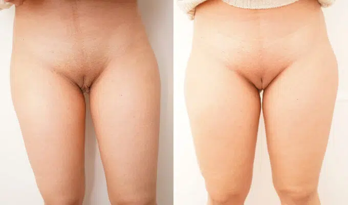 Female intimate area before and after cosmetic procedures for the intimate area Dr. Benjamin Sarfati Paris