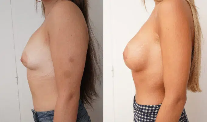 Poitrine de femme avant et apres correction de sein tubereux par prothese Dr Benjamin Sarfati Paris