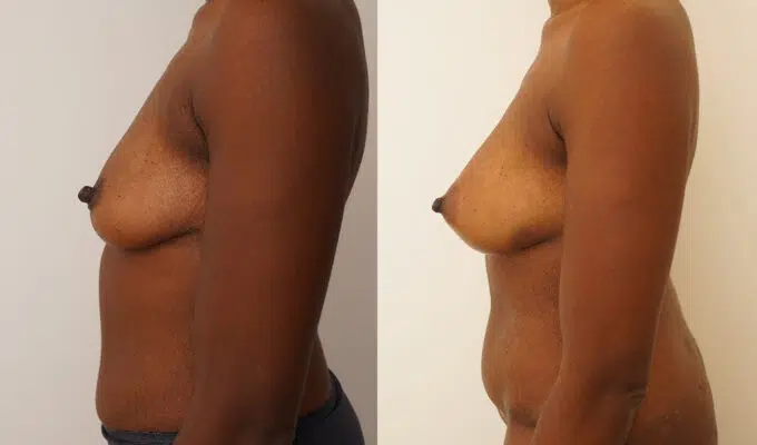 Poitrine avant et apres une augmentation mammaire par injection de graisse Lipofilling Dr Benjamin Sarfati paris