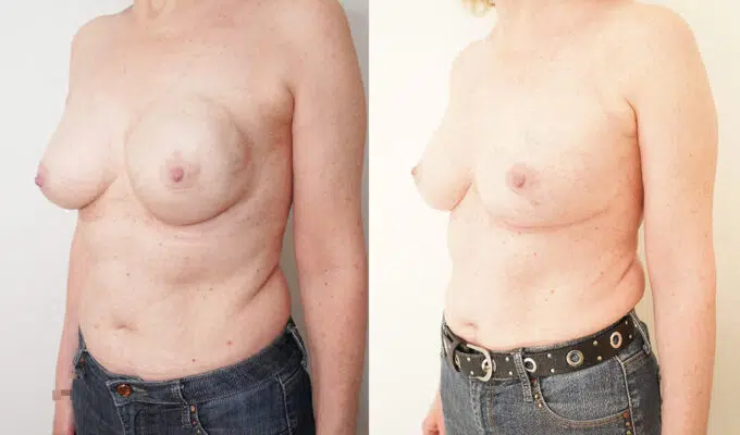 Poitrine de femme avant et apres reconstruction mammaire secondaire gauche par prothese Dr Benjamin Sarfati paris