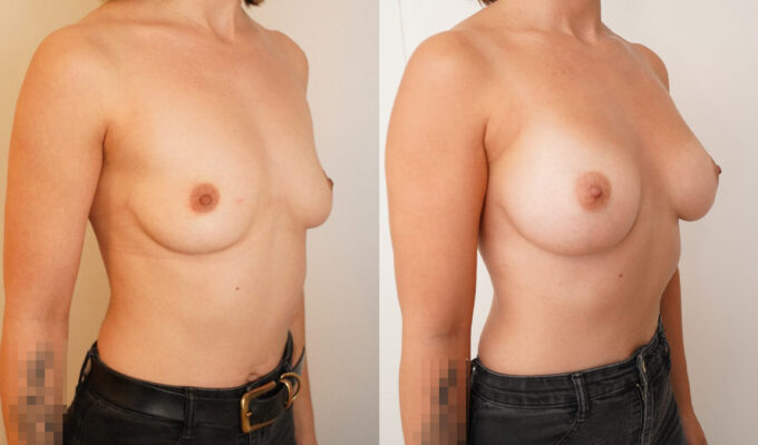 Breast augmentation with implants | Before/after | Dr. Benjamin Sarfati | Paris