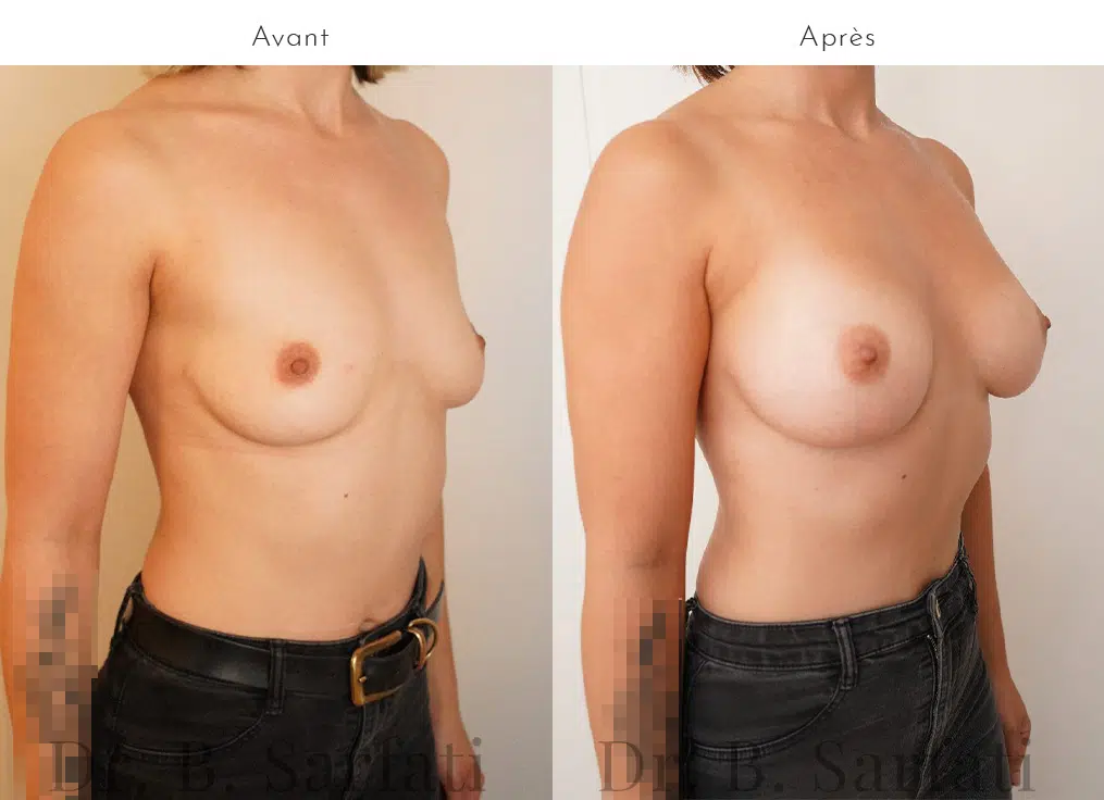 Augmentation mammaire par prothèse | Avant/après | Dr Benjamin Sarfati | Paris