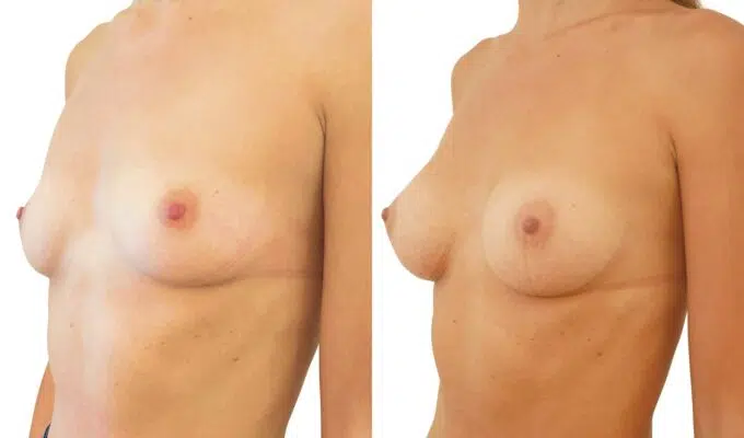 Breast augmentation using the MIA procedure: three-quarter view | Before/after | Dr. Benjamin Sarfati | Paris