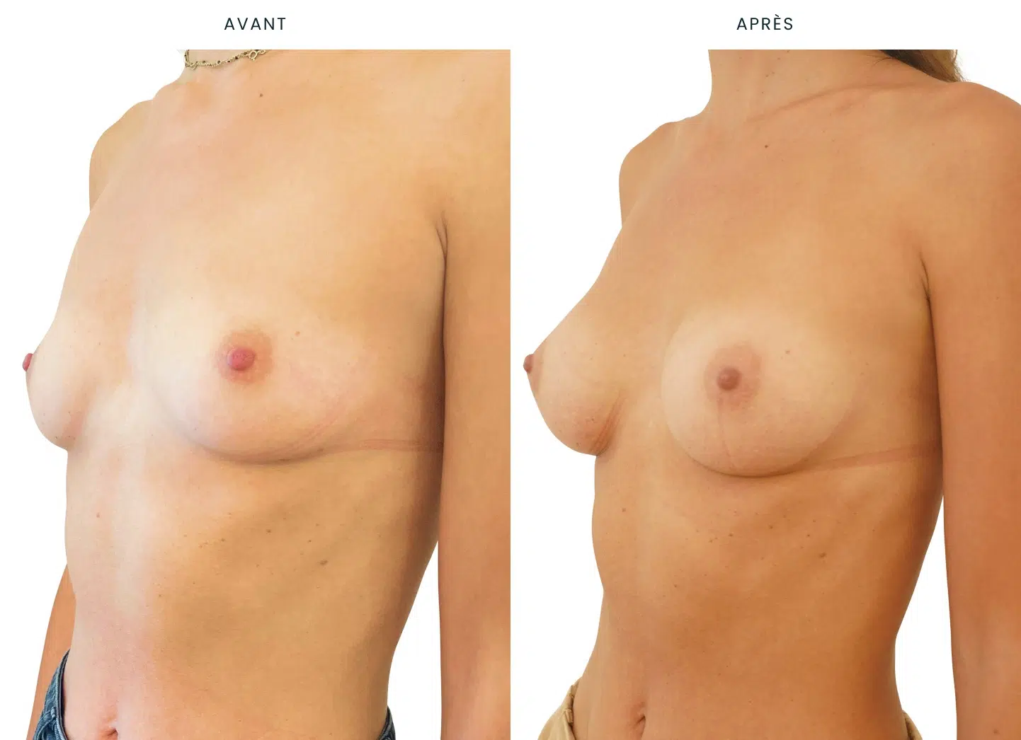 Augmentation mammaire par Procédé MIA : vue de 3/4 | Avant/après | Dr Benjamin Sarfati | Paris