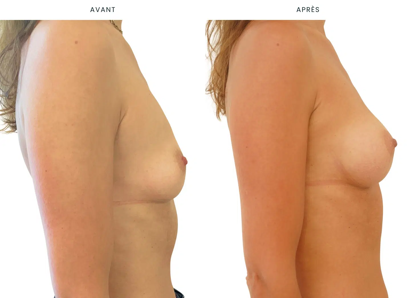 Poitrine de femme avant et apres une augmentation mammaire par prothese 160cc procede Mia Dr Benjamin Sarfati paris