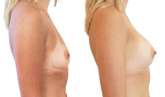 Augmentation mammaire par Procédé MIA : vue profil | Avant/après | Dr Benjamin Sarfati | Paris