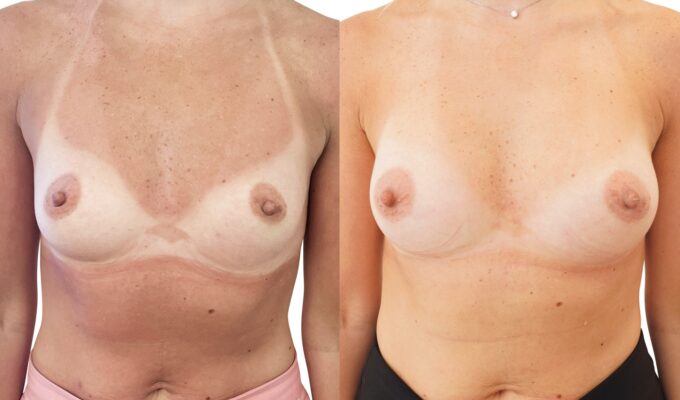 Augmentation mammaire par Procédé MIA : vue de face | Avant/après | Dr Benjamin Sarfati | Paris