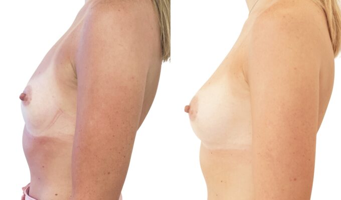 Augmentation mammaire par Procédé MIA : vue profil | Avant/après | Dr Benjamin Sarfati | Paris