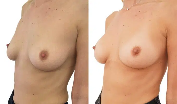 Breast augmentation using the MIA procedure: three-quarter view | Before/after | Dr. Benjamin Sarfati | Paris