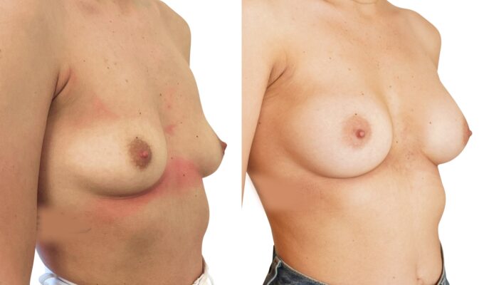 Augmentation mammaire par Procédé MIA : vue de 3/4 | Avant/après | Dr Benjamin Sarfati | Paris