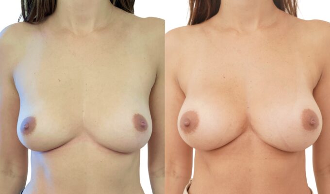 Augmentation mammaire par Procédé MIA : vue de face | Avant/après | Dr Benjamin Sarfati | Paris