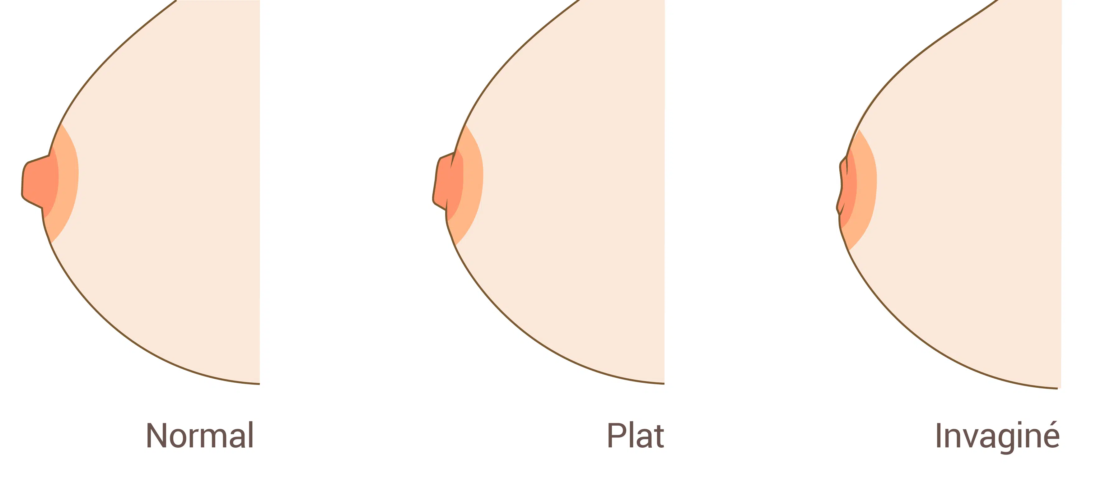 Les types des mamelons invagines | Dr Benjamin Sarfati | Paris