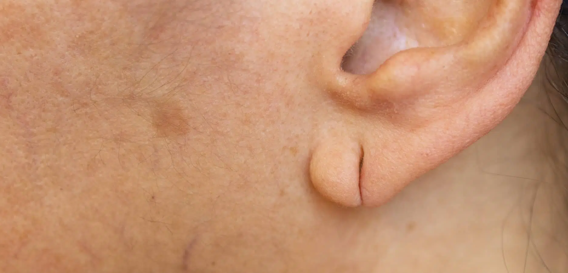 Réparation des lobes d’oreilles : les conseils post-opératoires | Dr Sarfati | Paris