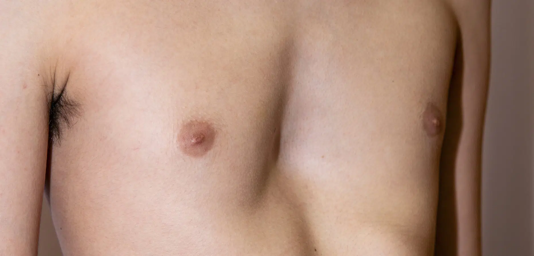 Les conseils du Dr Sarfati à Paris pour traiter un syndrome de Poland