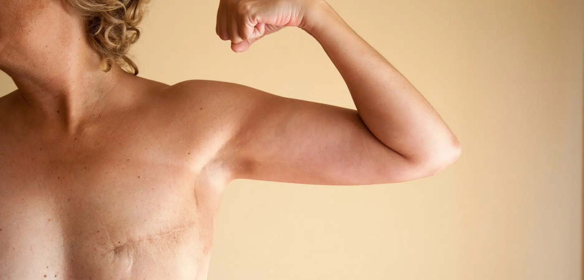 Les solutions post mastectomie avec le Dr Sarfati à Paris