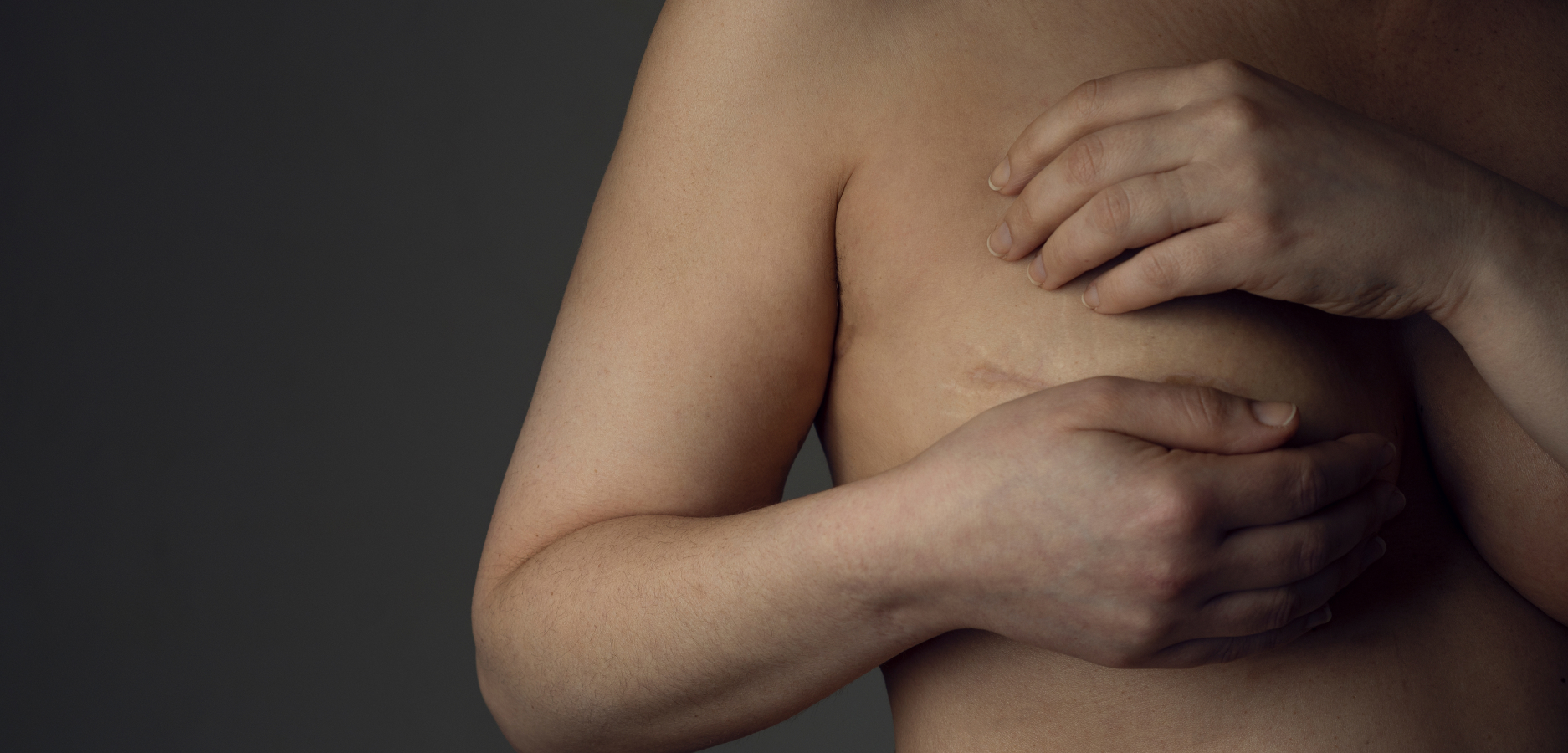 Cicatrices après reduction mammaire